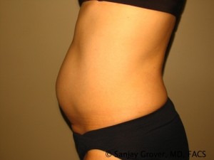 Tummy Tuck Before and After 40 | Sanjay Grover MD FACS