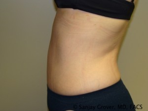 Tummy Tuck Before and After 40 | Sanjay Grover MD FACS