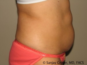 Tummy Tuck Before and After 41 | Sanjay Grover MD FACS