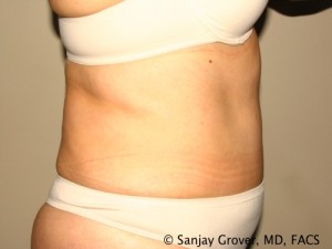 Tummy Tuck Before and After 41 | Sanjay Grover MD FACS