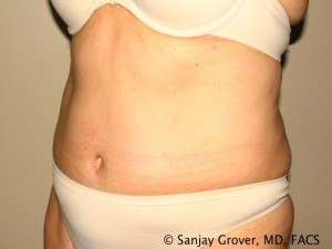 Tummy Tuck Before and After 41 | Sanjay Grover MD FACS