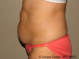 Tummy Tuck Before and After 41 | Sanjay Grover MD FACS