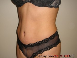 Tummy Tuck Before and After 42 | Sanjay Grover MD FACS