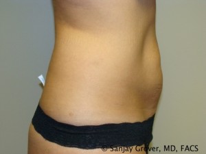 Tummy Tuck Before and After 43 | Sanjay Grover MD FACS