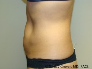 Tummy Tuck Before and After 43 | Sanjay Grover MD FACS