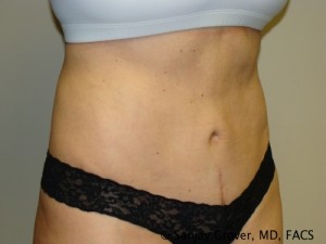 Tummy Tuck Before and After 45 | Sanjay Grover MD FACS