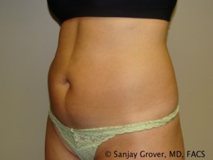 Tummy Tuck Before and After 45 | Sanjay Grover MD FACS