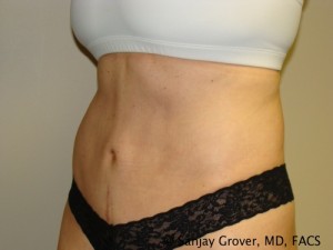 Tummy Tuck Before and After 45 | Sanjay Grover MD FACS