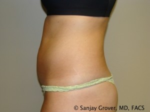 Tummy Tuck Before and After 45 | Sanjay Grover MD FACS