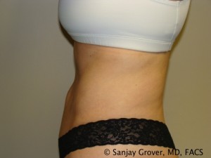 Tummy Tuck Before and After 45 | Sanjay Grover MD FACS