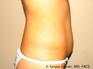 Tummy Tuck Before and After 46 | Sanjay Grover MD FACS