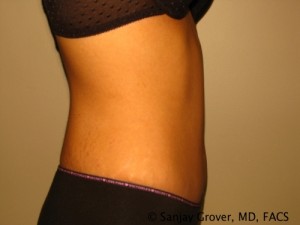 Tummy Tuck Before and After 46 | Sanjay Grover MD FACS