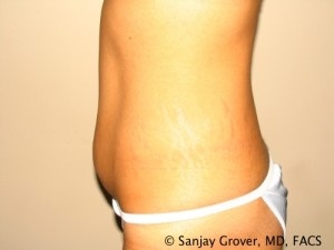 Tummy Tuck Before and After 46 | Sanjay Grover MD FACS