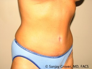 Tummy Tuck Before and After 47 | Sanjay Grover MD FACS