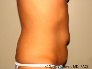 Tummy Tuck Before and After 47 | Sanjay Grover MD FACS