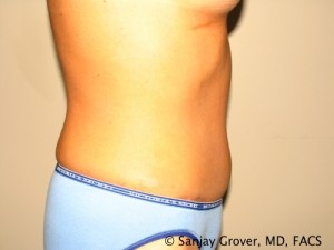 Tummy Tuck Before and After 47 | Sanjay Grover MD FACS