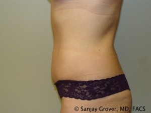 Tummy Tuck Before and After 48 | Sanjay Grover MD FACS