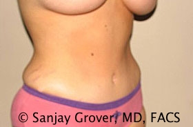 Tummy Tuck Before and After 49 | Sanjay Grover MD FACS