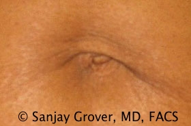 Tummy Tuck Before and After 51 | Sanjay Grover MD FACS