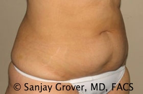 Tummy Tuck Before and After 52 | Sanjay Grover MD FACS