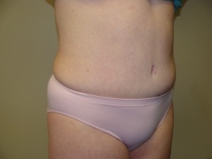 Tummy Tuck Before and After 56 | Sanjay Grover MD FACS