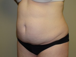 Tummy Tuck Before and After 56 | Sanjay Grover MD FACS