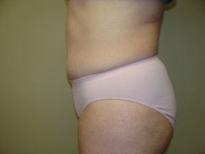 Tummy Tuck Before and After 56 | Sanjay Grover MD FACS