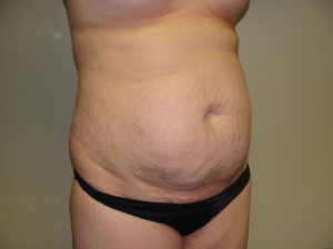 Tummy Tuck Before and After 57 | Sanjay Grover MD FACS