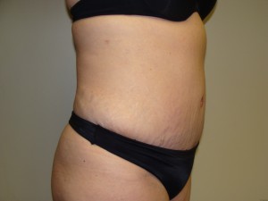 Tummy Tuck Before and After 57 | Sanjay Grover MD FACS