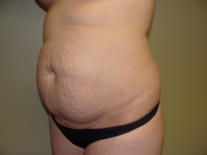 Tummy Tuck Before and After 57 | Sanjay Grover MD FACS