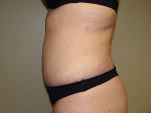 Tummy Tuck Before and After 57 | Sanjay Grover MD FACS