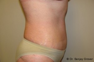 Tummy Tuck Before and After 58 | Sanjay Grover MD FACS