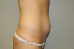 Tummy Tuck Before and After 59 | Sanjay Grover MD FACS