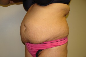 Tummy Tuck Before and After 60 | Sanjay Grover MD FACS