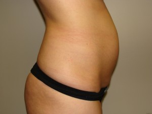 Tummy Tuck Before and After 61 | Sanjay Grover MD FACS