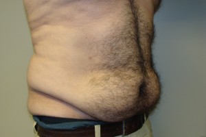 Tummy Tuck Before and After 62 | Sanjay Grover MD FACS