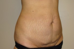 Tummy Tuck Before and After 64 | Sanjay Grover MD FACS