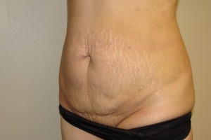 Tummy Tuck Before and After 64 | Sanjay Grover MD FACS