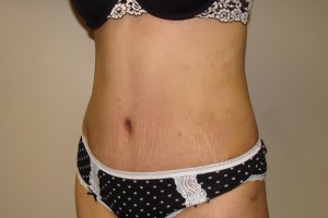 Tummy Tuck Before and After 64 | Sanjay Grover MD FACS