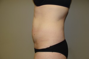 Tummy Tuck Before and After 65 | Sanjay Grover MD FACS