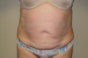 Tummy Tuck Before and After 62 | Sanjay Grover MD FACS
