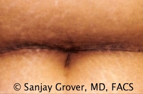 Tummy Tuck Before and After 67 | Sanjay Grover MD FACS