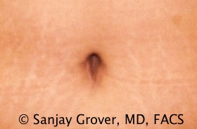 Tummy Tuck Before and After 67 | Sanjay Grover MD FACS