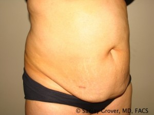 Tummy Tuck Before and After 68 | Sanjay Grover MD FACS