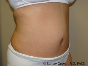 Tummy Tuck Before and After 68 | Sanjay Grover MD FACS