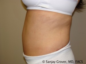 Tummy Tuck Before and After 68 | Sanjay Grover MD FACS