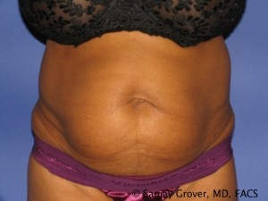 Tummy Tuck Before and After 01 | Sanjay Grover MD FACS