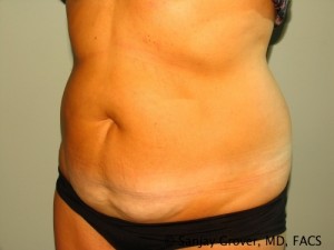 Tummy Tuck Before and After 73 | Sanjay Grover MD FACS