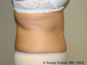 Tummy Tuck Before and After 73 | Sanjay Grover MD FACS