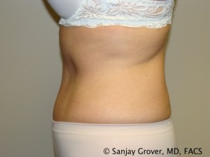 Tummy Tuck Before and After 73 | Sanjay Grover MD FACS